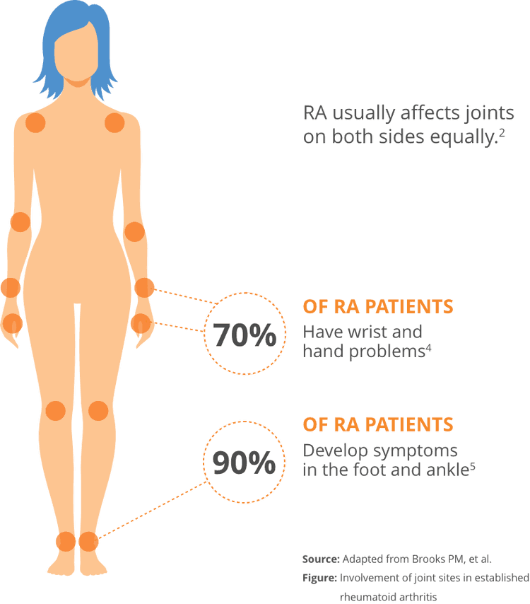Indication Disease Overview Otrexup methotrexate Injection For indication-disease-overview-otrexup-methotrexate-injection-for